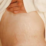 Stretch marks on the abdomen showing natural skin texture prior to treatment